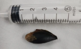 Lấy thành công hạt hồng xiêm 26 năm 'nằm' trong phế quản cụ ông