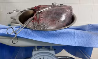 Bé trai được sinh ra cùng khối u nang buồng trứng 8kg trong bụng mẹ