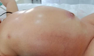 Bé trai 5 ngày tuổi bị thủng dạ dày bẩm sinh