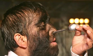 ‘Người sói’ nhét thìa vào mũi