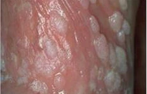Nam giới nhiễm virus HPV cũng tương đối phổ biến