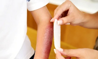 Những lưu ý khi chăm trẻ bị bỏng