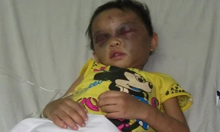 Bé gái 4 tuổi bị bố đẻ hành hung phải nhập viện 