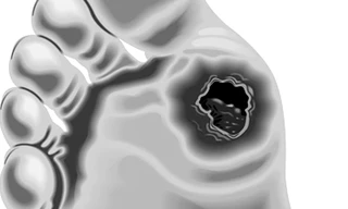 Bàn chân biến chứng tiểu đường