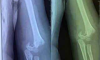 Hình ảnh chụp phim cho thấy trẻ bị gãy xương cánh tay. 