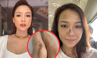 Loạt ảnh Sam "tả tơi" trên phim trường khiến fan xót xa: Chân bầm tím, mặt sưng phù