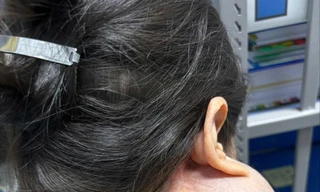 Bệnh nhân với khối u khổng lồ trên mặt