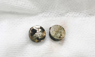 Lấy pin bị cháy khét trong mũi bé gái 6 tuổi