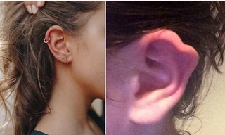 Bị nhiễm trùng khi bấm lỗ tai, nữ sinh phải phẫu thuật lấy khuyên ra và bị biến dạng tai