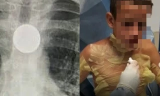 Cô bé 8 tuổi nhập viện khẩn cấp, suýt mất mạng vì bắt chước trò “ảo thuật” trên TikTok