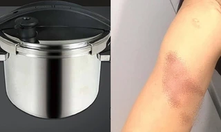 Đang nấu ăn thì nồi áp suất phát nổ: Một người mẹ bị bỏng nặng, em bé 2 tuổi thoát nạn