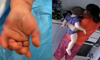Kinh hoàng cảnh người giúp việc ấn tay em bé 14 tháng tuổi vào nước đang sôi
