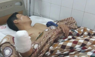 Bệnh nhân bị cụt tay