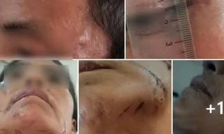 Bị đánh đập, treo lên cây do bị nghi làm bùa ngải khiến người khác tử vong