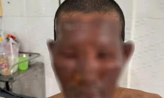 Nổ bình gas mini, 8 người đang ăn giỗ phải nhập viện