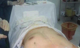 Hình ảnh một ca phẫu thuật nâng ngực ở nam giới.