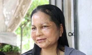 'Nữ sinh hóa bà lão' ở Hội An: Sức khỏe giảm sút