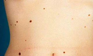 Nốt ruồi, khi nào là ung thư?