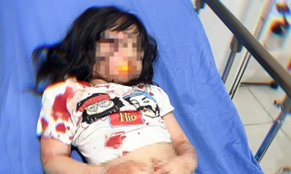 Chó dữ cắn bé gái ở Hà Giang trọng thương