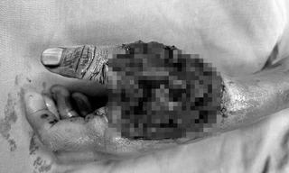 Bàn tay trái của em Q. bị dập nát, gãy ngón và lộ gân xương