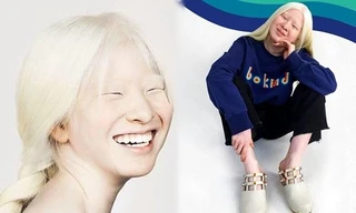 Cô bé bạch tạng bị bỏ rơi, nỗ lực vươn lên và trở thành người mẫu truyền cảm hứng 