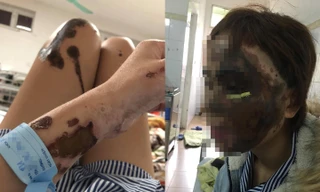 Bị chồng chưa cưới là cựu thiếu úy công an tạt axit, một nửa gương mặt của L.T.L.V bị hủy hoại, cùng với đó là nhiều vết bỏng nặng ở tay, chân