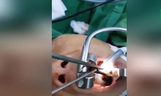 Bản tin 8H: Bác sĩ gắp đỉa sống trong họng bệnh nhân Hà Giang