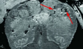 Các nhà khoa học nghiên cứu cơ chế virus SARS-CoV-2 xâm nhập vào đầu.