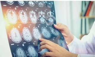 Các chuyên gia đã chụp bộ náo các bệnh nhân căn bệnh bí ẩn này để tìm nguyên nhân.