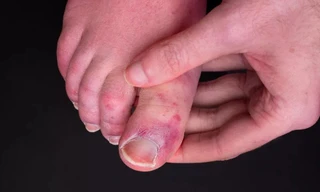 Nhiều người sau khi mắc COVID-19 lại bị phát ban ở ngón chân.