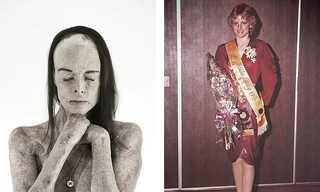 Câu chuyện xúc động sau bức ảnh khoả thân của nữ hoàng sắc đẹp bị bỏng 85% 