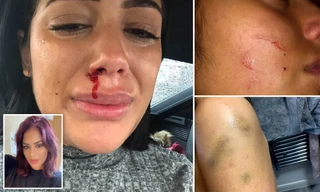 Sao truyền hình Anh bị bạn trai bạo hành đến gãy xương