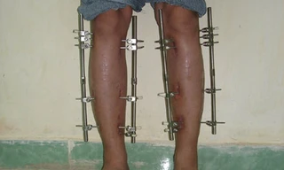 Kéo dài chân một cm mất 25 ngày