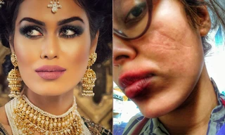 Hoa hậu Anh bị tổn thương mặt vì đeo khẩu trang quá nhiều khi làm bác sĩ chống COVID-19