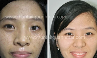 Nhiều bạn trẻ đau khổ vì mụn thịt