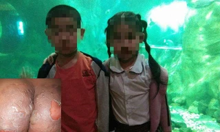 Hai cháu bé bị bỏng do bị hắt nước sôi vào người.