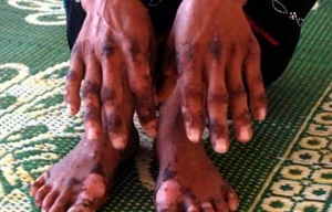 Thêm 2 ca tử vong do viêm da dày sừng bàn tay