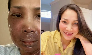 Hồng Ngọc đúc kết điều quý giá sau tai nạn bỏng nặng mặt và ngực