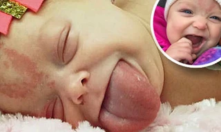 Paisley Morrison-Johnson bị mắc Hội chứng hiếm gặp Wiedemann Beckwith với cái lưỡi gấp đôi bình thường