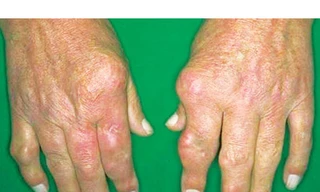 Viêm đa khớp dạng thấp