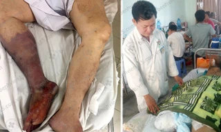 Cắt bỏ chân vì hoại tử do uống thuốc tim mạch không đều