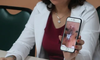 Tiêm filler tại cơ sở chui, nữ sinh viên bị hoại tử mũi