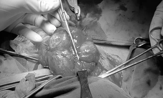 Cụ bà 74 tuổi mang khối bướu cổ gần 50 năm