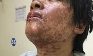 Biến dạng khuôn mặt vì tự ý dùng thuốc đau đầu