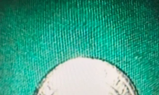 Bàng hoàng phát hiện đồng xu nằm trong thực quản bé gái 5 tuổi