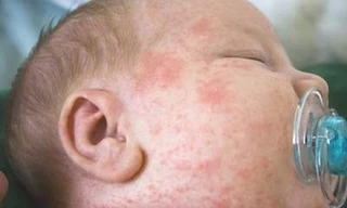 Dịch sởi gia tăng tại TPHCM