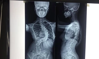 Sau phẫu thuật vẹo cột sống, thiếu nữ tăng 7 cm chiều cao