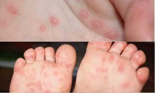Chủng virus gây đại dịch tay chân miệng năm 2011 đã trở lại?