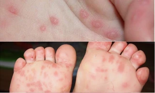 Chủng virus gây đại dịch tay chân miệng năm 2011 đã trở lại?