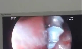 Gắp thành công đinh xoắn ốc ra khỏi dạ dày bé gái 2 tuổi